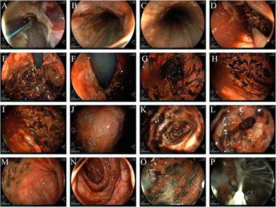 Case Report: Upper gastrointestinal bleeding and multiorgan injury caused by ethylicin poisoning